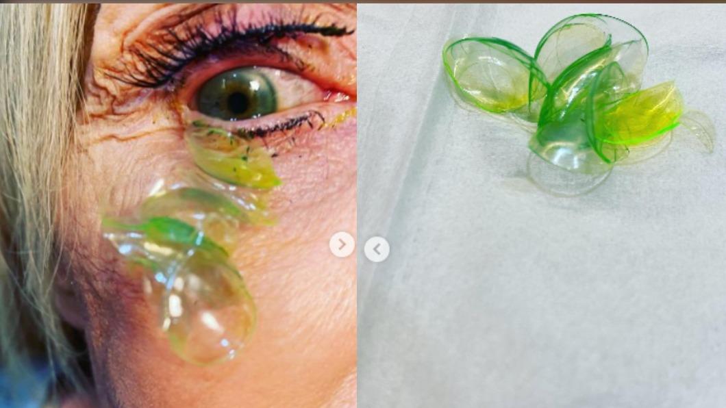 醫生從女子眼中取出23片隱形眼鏡。（圖／翻攝自california_eye_associates IG）