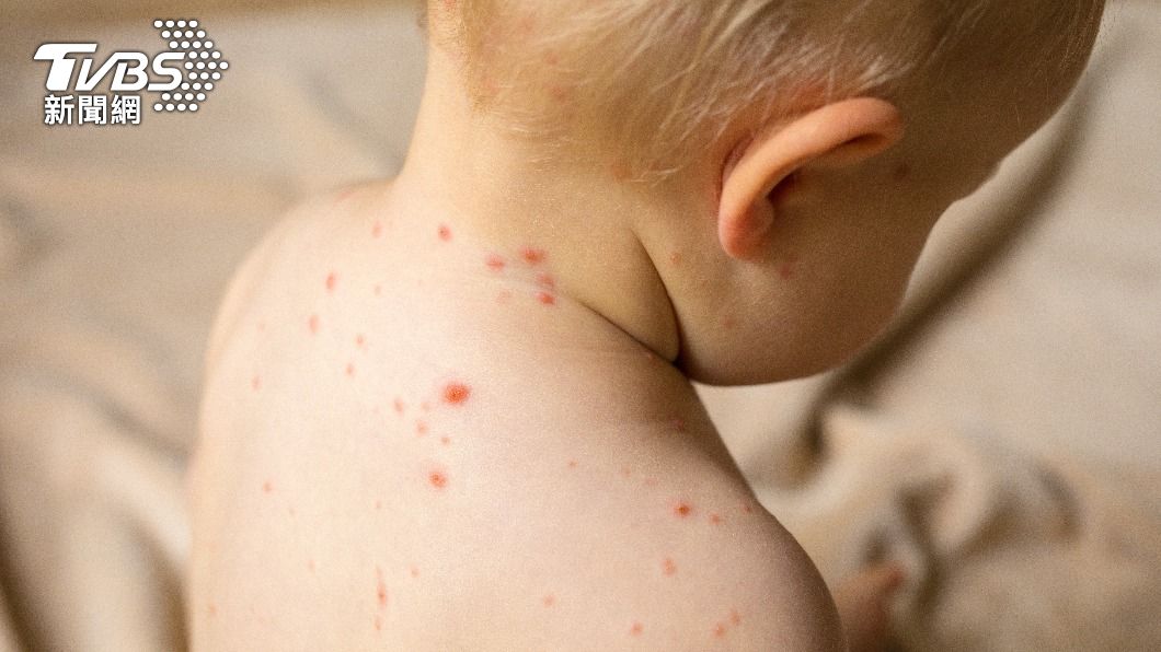 全球近日麻疹疫情頻傳。（示意圖／shutterstock達志影像）