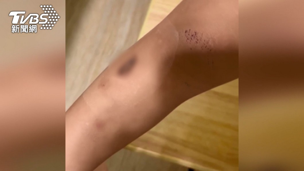 圖／TVBS 公園玩滑梯遭線香燙傷！2歲女童腿留瘀青深疤