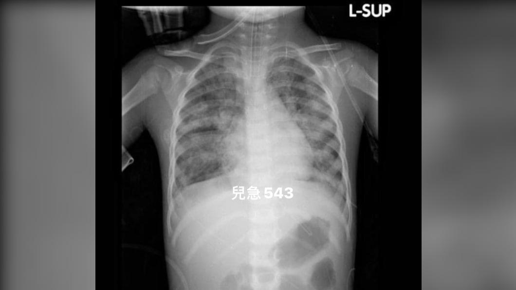 吳昌騰分享兒童嚴重RSV感染的胸部X光片。 （圖／翻攝吳昌騰臉書）