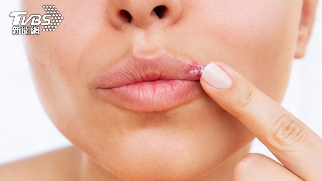 唇炎可能會讓嘴唇紅腫刺痛。（示意圖／shutterstock達志影像）