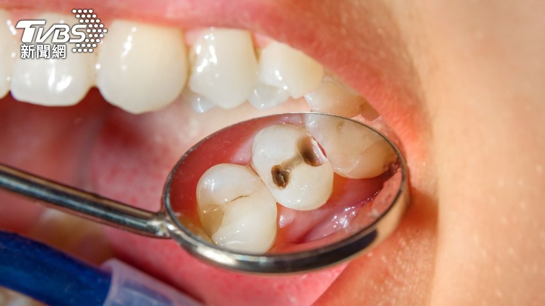 許多人因為長智齒刷不乾淨而導致蛀牙。（示意圖／shutterstock達志影像）