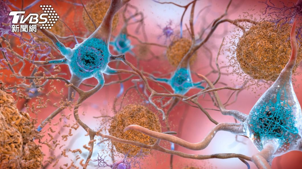 阿茲海默症患者大腦中有β-澱粉樣蛋白聚集形成的斑塊。（示意圖／shutterstock達志影像）