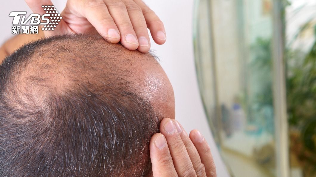 除了因荷爾蒙導致禿頭外，壓力也可能是原因之一。（示意圖／Shutterstock達志影像）