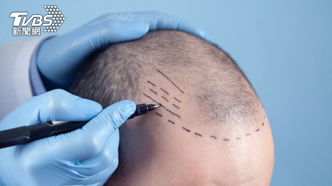印度男子拉希德因為失敗的植髮手術引發敗血症離世。（示意圖，非本文當事人／Shutterstock達志影像）