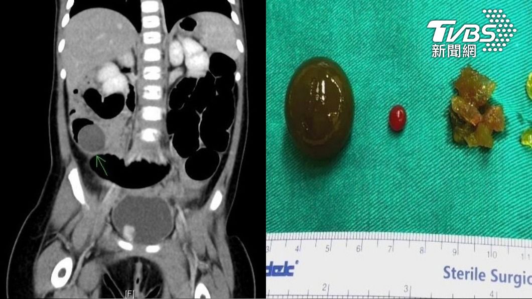童誤吞水晶寶寶，腸子塞爆險死。（圖／TVBS）