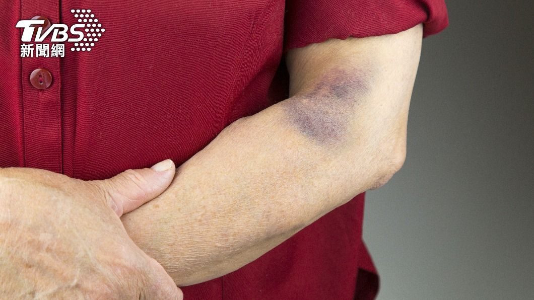 病患手臂出現詭異瘀青、才發現原來是系統性疾病作祟。（示意圖／Shutterstock達志影像）