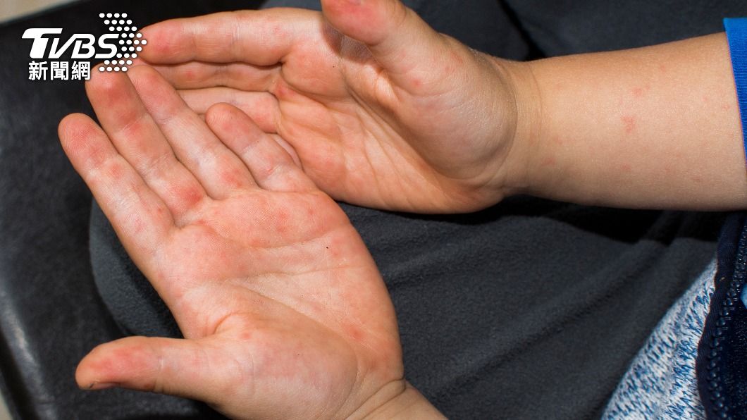 手掌不尋常的發紅可能是「肝掌」症狀。（示意圖／Shutterstock達志影像）