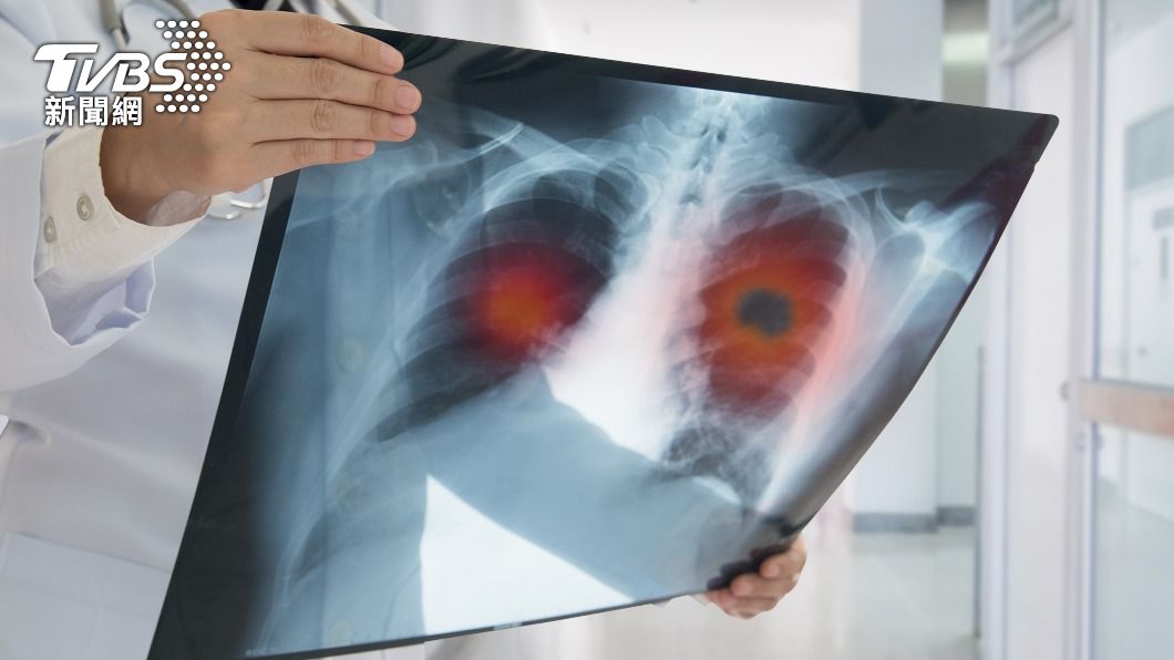 肺腺癌早期徵兆常被誤認為感冒。（示意圖／shutterstock達志影像）