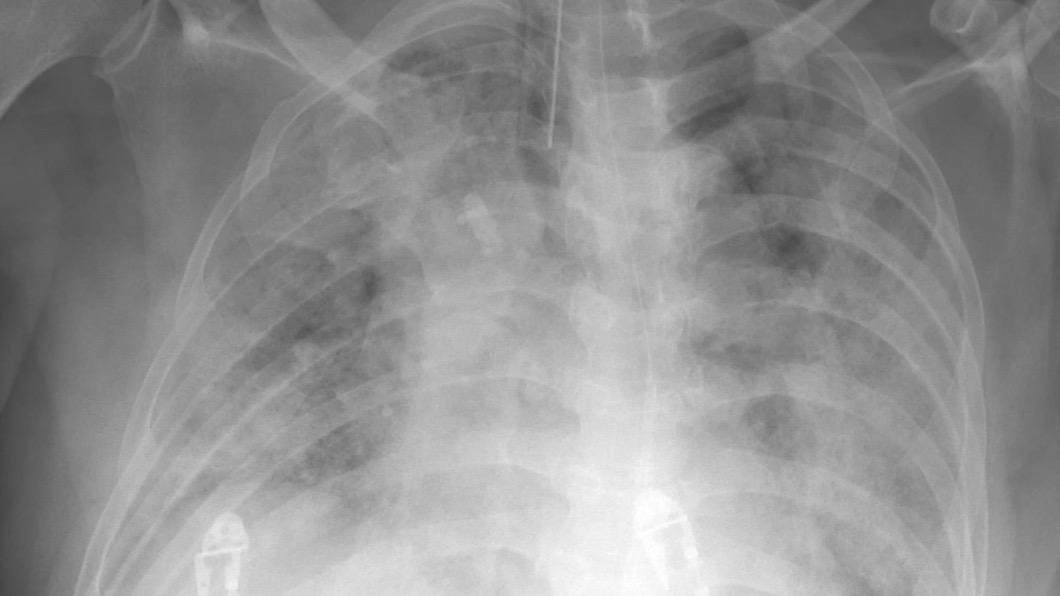 蘇一峰在臉書PO出一張患者「大白肺」的X光片。（圖／翻攝蘇一峰臉書） 台商「大白肺」抗病毒藥物也擋不住　醫：留中國死路一條