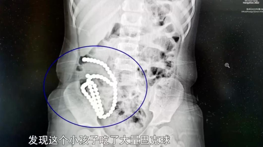 一長串白點卡在女童腸道中，讓她持續腹痛，醫生發現竟是多達61顆的巴克球。（圖／翻攝自微博）