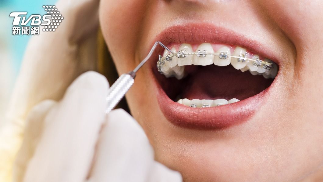 日本一家牙科診所以「免費矯正牙齒」為宣傳，受害者實際接受矯正後，卻發現整套服務根本不是免費的。（示意圖／shutterstock達志影像）