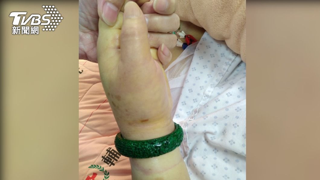 婦人的百萬翡翠手鐲卡住造成手部腫脹。（圖／TVBS）