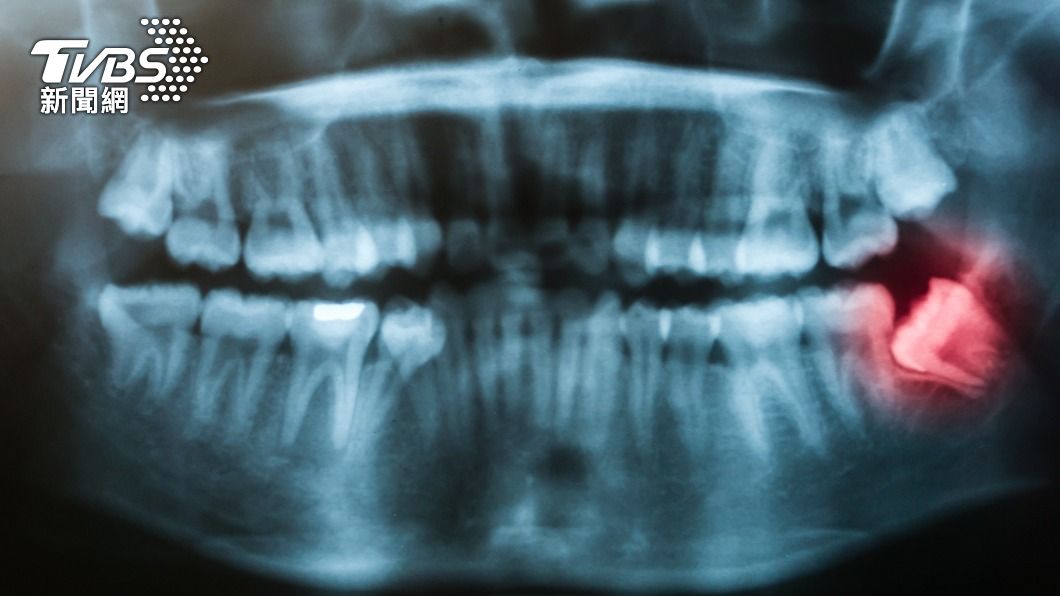 牙裂在牙科門診中不算罕見。（示意圖／Shutterstock達志影像）