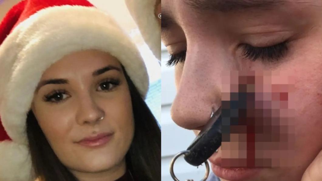 加拿大24歲女子蕾妮（Renée Lariviere）臉部日前遭朋友隨手扔的鑰匙插入。（圖／翻攝自《紐約郵報》）