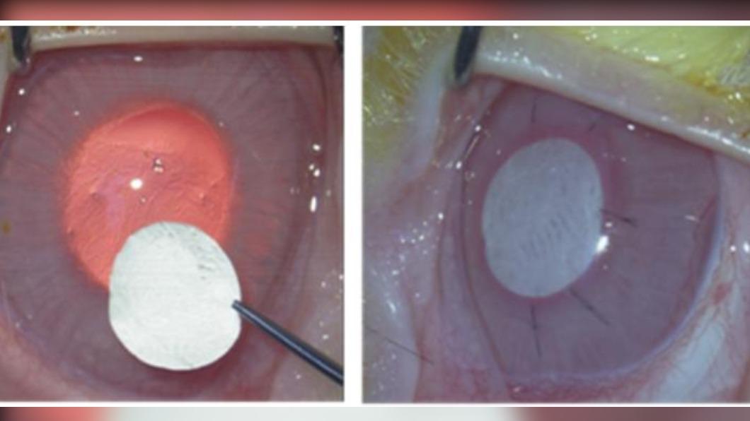 電紡紗人工角膜移植動物實驗過程。（圖／台大醫院提供）