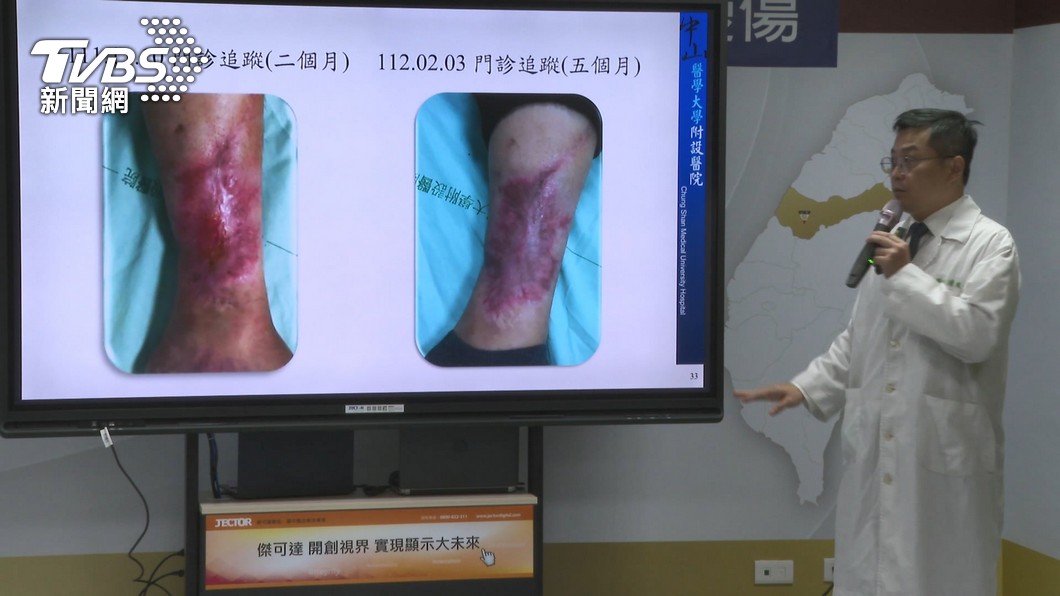 圖／TVBS  女遭撞腳粉碎性骨折！幹細胞治療　還她行走