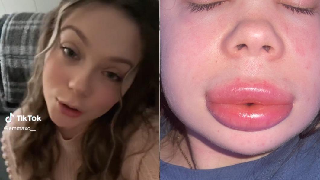 艾瑪的雙唇在豐唇手術後逐漸腫大。（圖／翻攝自emmaxc__ Tik Tok）