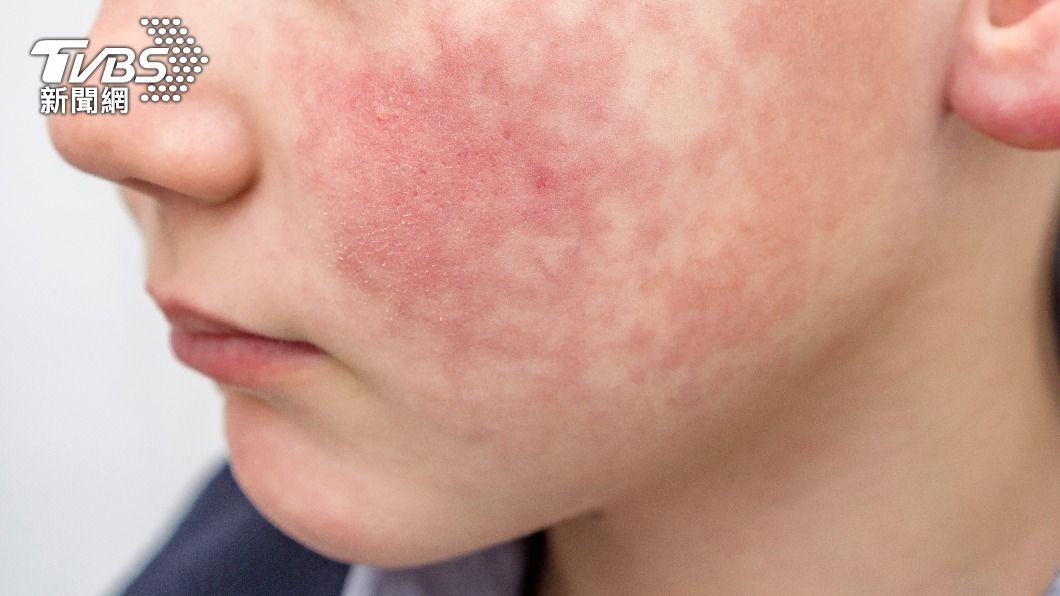 小6童皮膚出現白色皮屑，沒多久轉變成紅疹。（示意圖，非當事人／shutterstock達志影像）