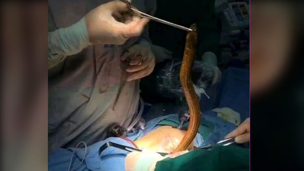 醫生從波蘭男子體內取出「活跳跳鰻魚」。（圖／翻攝自《每日星報》）