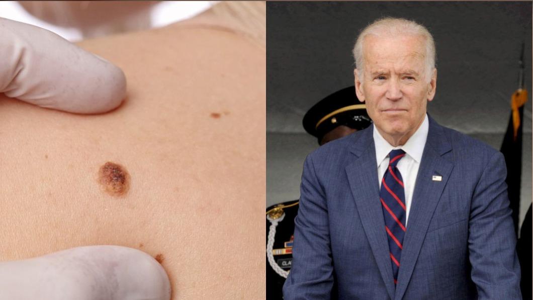 美國總統拜登（右）罹患皮膚癌。（圖／shutterstock達志影像、達志影像美聯社）