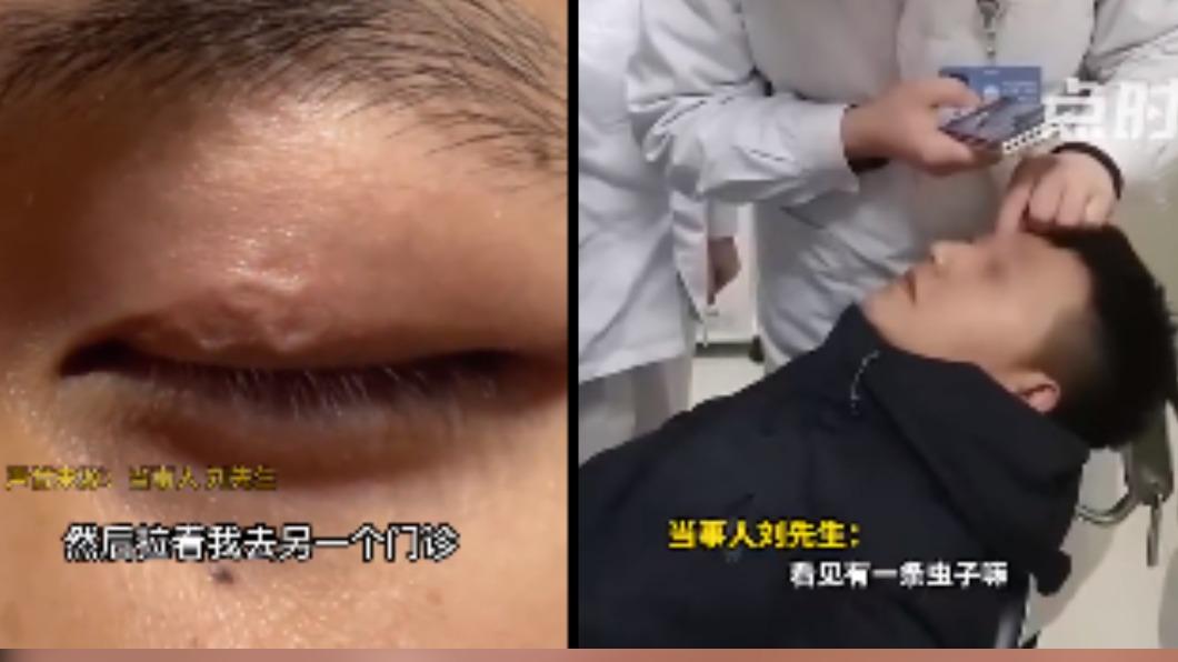 男子發現眼皮下有寄生蟲。（圖／翻攝自點時新聞、微博）