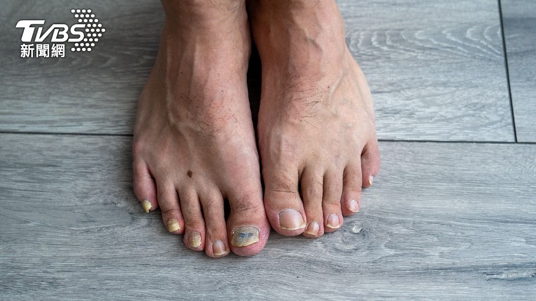 脫下鞋襪後，有灰指甲的患者往往覺得好尷尬。（示意圖／shutterstock達志影像）