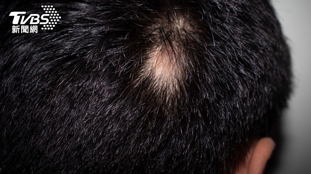頭頂痘痘好不了可能是癌症警訊。（示意圖／Shutterstock達志影像）
