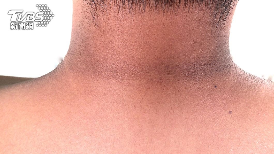 脖子黑色素沉澱可能是黑色棘皮症。（示意圖／shutterstock達志影像）