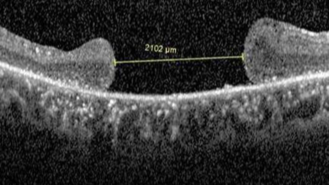 手術前的光學電腦斷層掃描圖顯示，黃斑部裂孔已達2100微米。(圖/花蓮慈濟醫院提供)