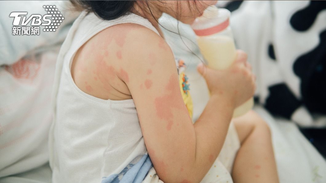 皮膚紅腫發癢是食物過敏常見的症狀。（示意圖／shutterstock達志影像） 