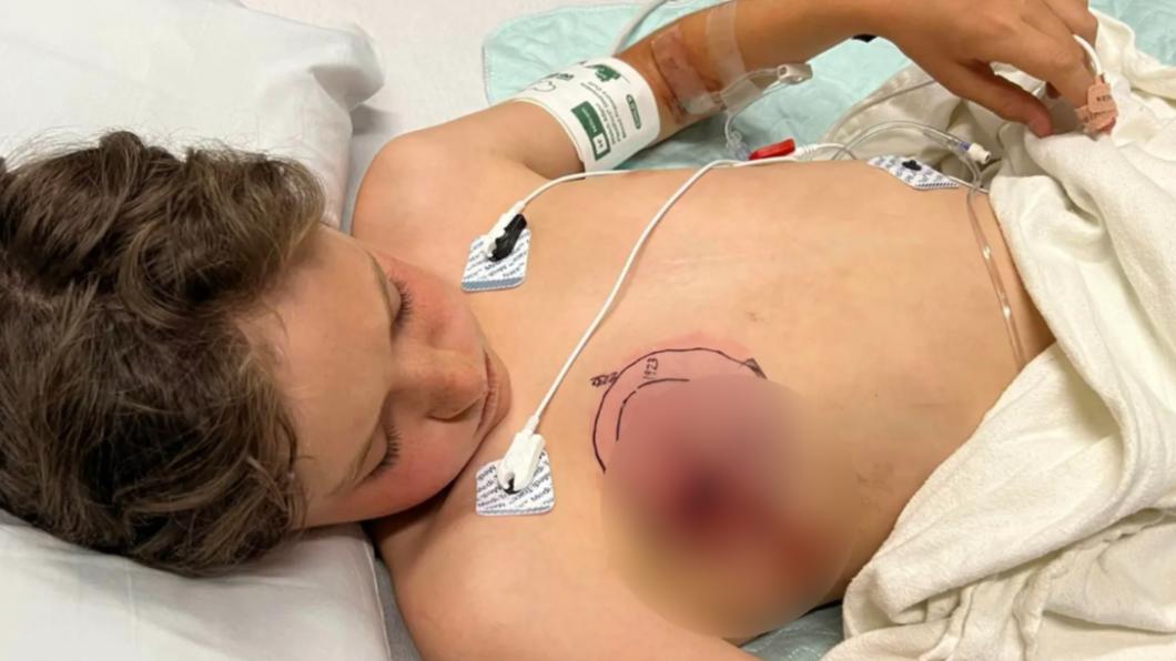 美國科羅拉多州（Colorado）11歲男童伊桑（Ethan Vogel）騎單車自摔「壓到響尾蛇」，右胸被毒牙刺傷。（圖／翻攝自《紐約郵報》）