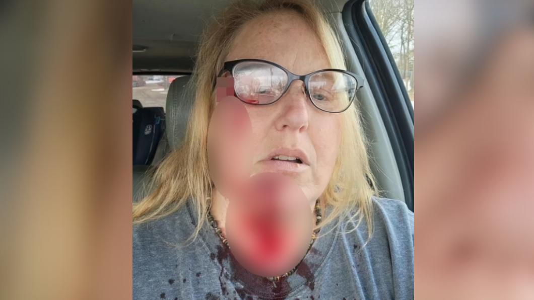  50歲婦人朗達（Rhonda Stickney）被鬥牛犬咬到血流滿面。（圖／翻攝自《每日郵報》）