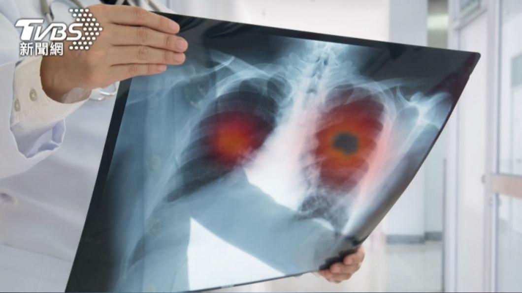 男性車禍照X光，意外發現肺腺癌。（示意圖，非當事人／shutterstock達志影像）