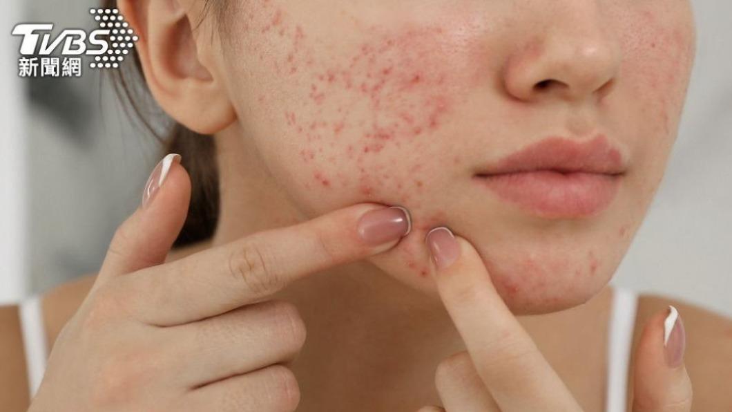 長痘痘是很常見的肌膚問題。 （示意圖／shutterstock達志影像） 