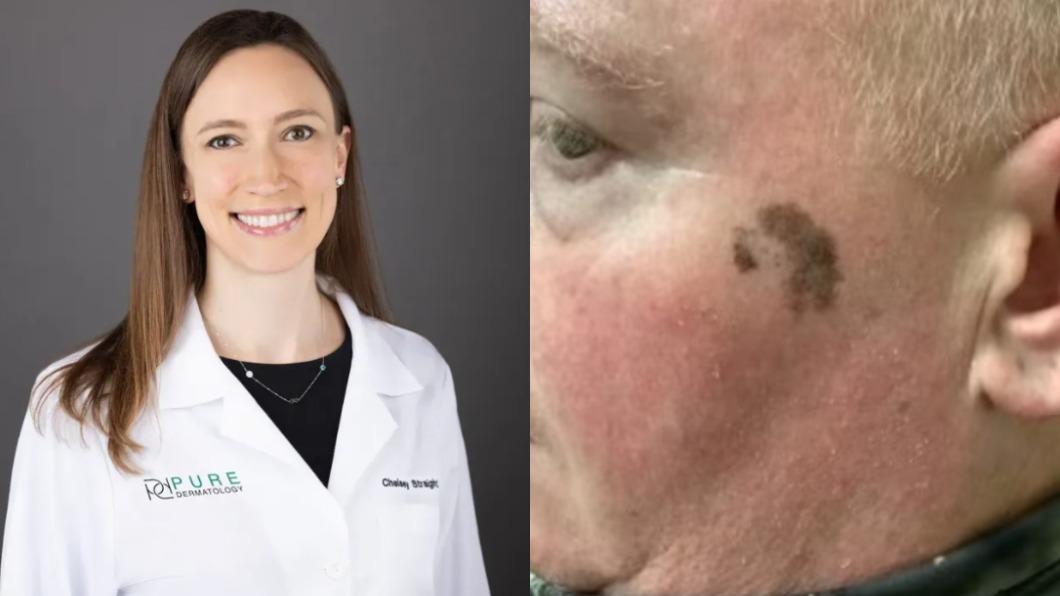 皮膚科醫師史特雷特和丈夫看到男子臉上有不規則黑斑。（圖／翻攝自Pure Dermatology、《每日郵報》）