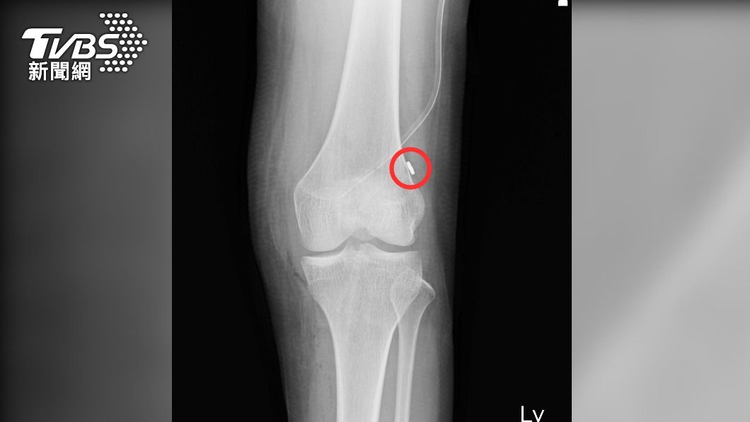蒙古排球少女膝關節十字靭帶斷裂  跨台求助員榮骨科重建