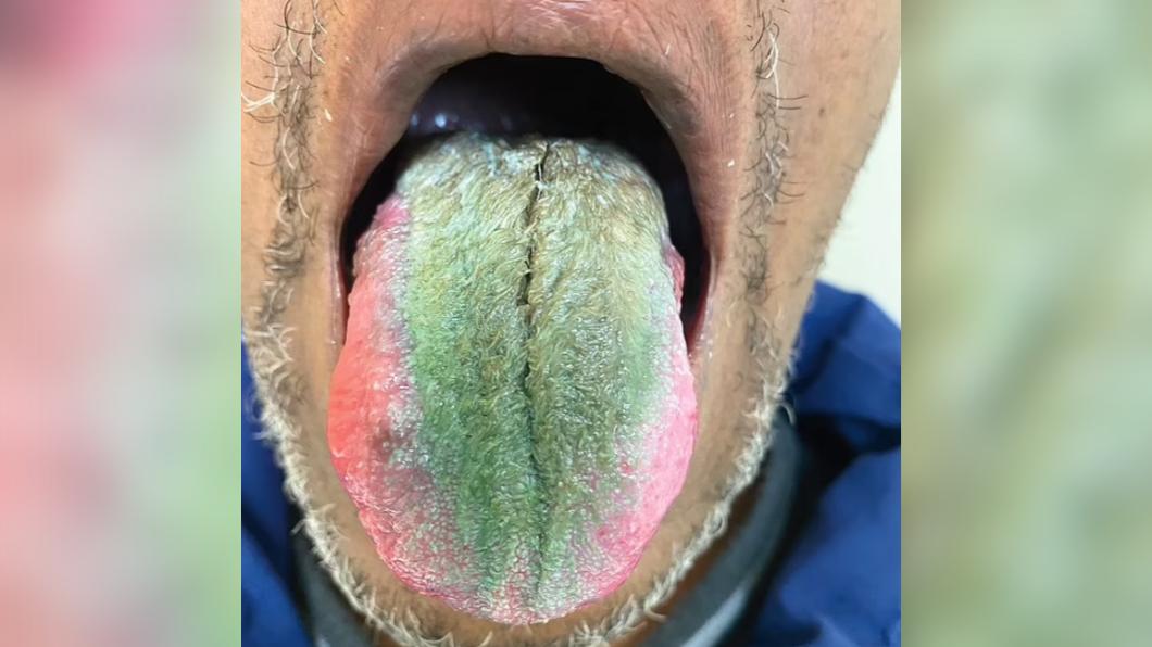 64歲男「舌長綠毛」急求醫，被診斷為毛舌（Hairy Tongue）。（圖／翻攝自《每日郵報》）