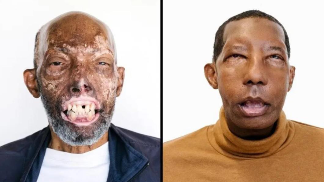 美國男子接受「全臉移植手術」後「重獲新臉」。（圖／翻攝自《紐約郵報》）