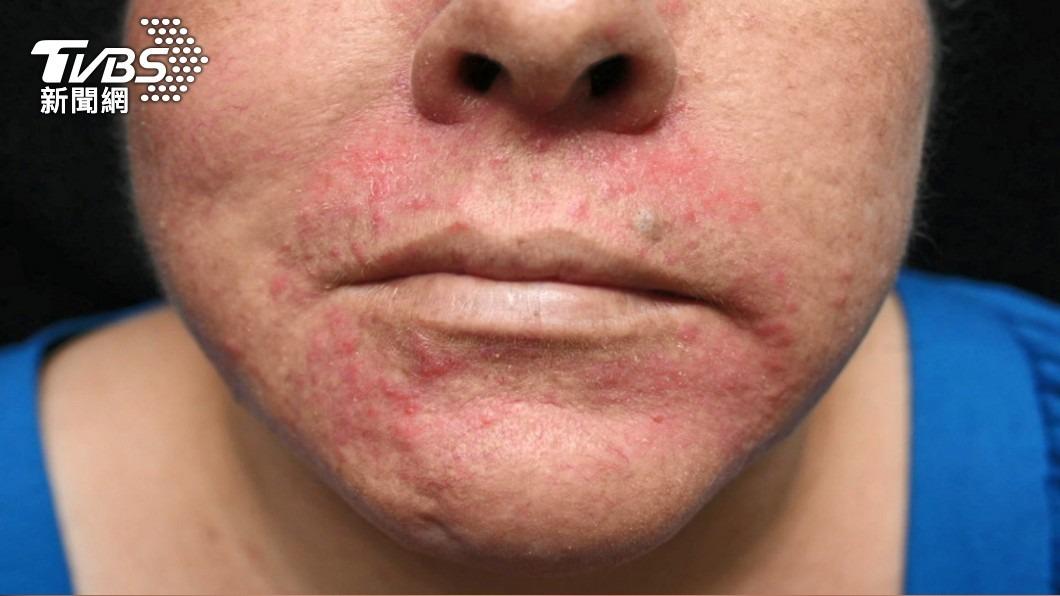 皮膚脫屑泛紅也許是脂漏性皮膚炎。（圖／TVBS資料畫面）