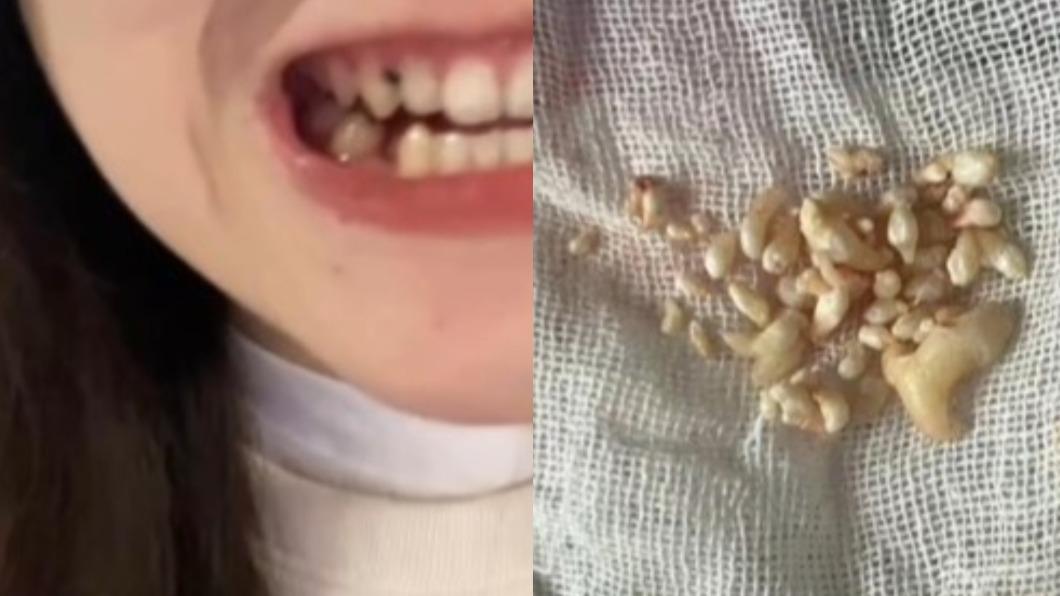 女子被清出57顆牙。（圖／翻攝自微博《梧桐Video》）