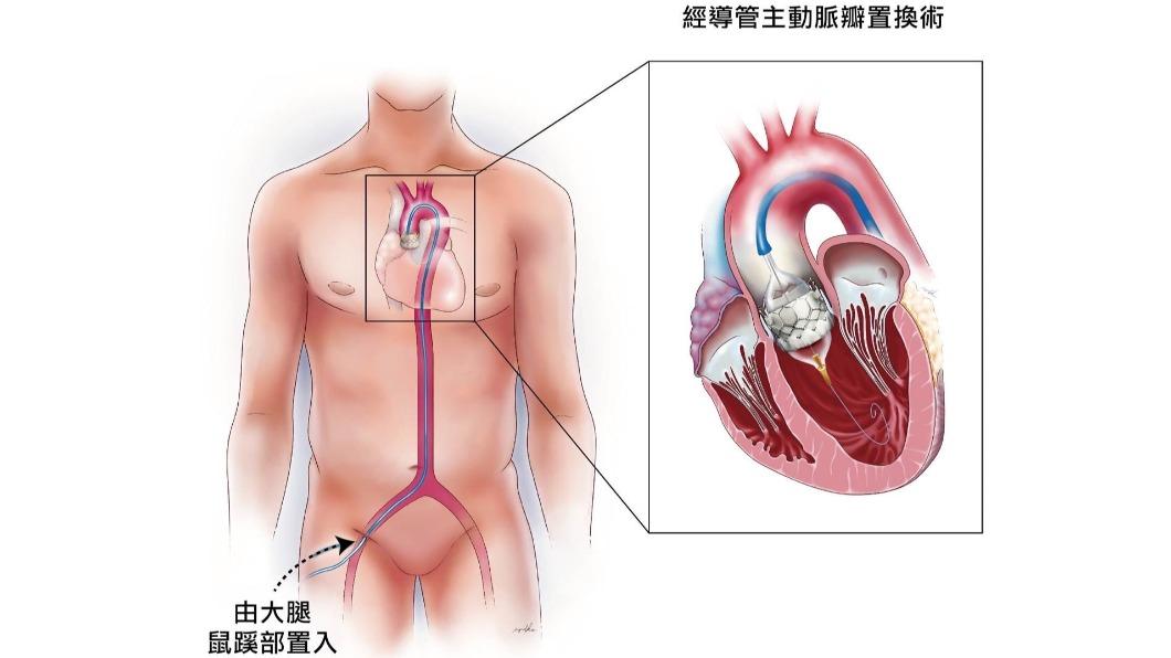 導管主動脈瓣膜置換手術。（圖／院方提供）