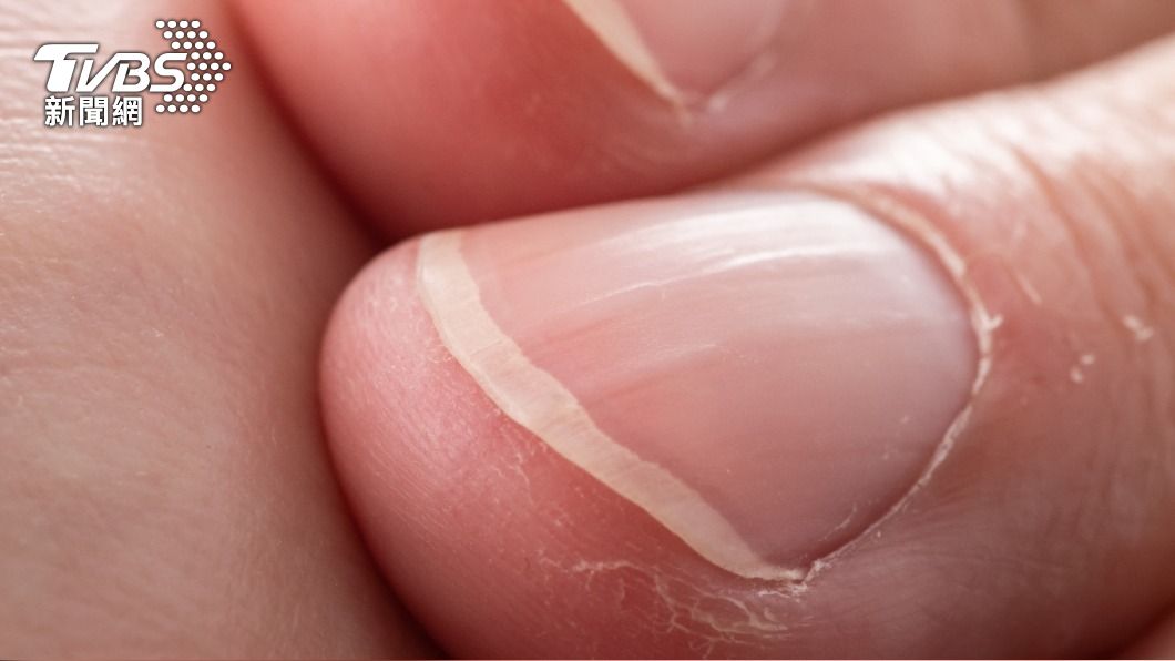 指甲表面有凸起的線可能是肝臟積毒。（示意圖／shutterstock達志影像） 