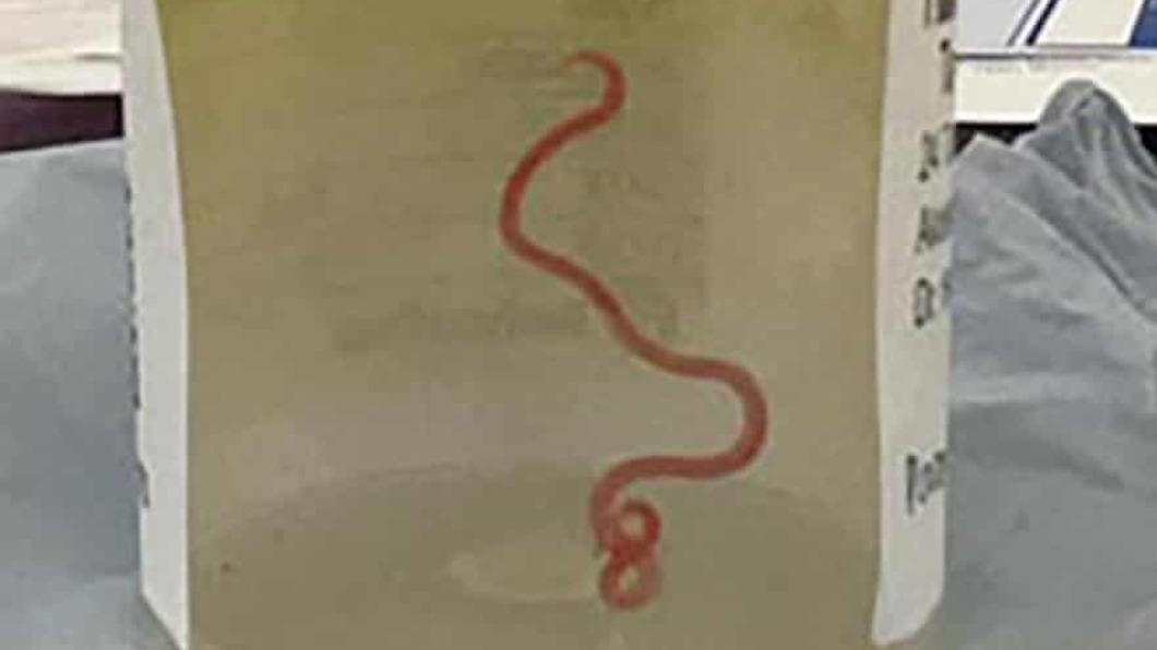 一名澳洲婦女因持續腹痛、腹瀉及發燒到醫院就醫，結果醫生從她的大腦中取出一條長8公分的寄生蟲。（圖／翻攝自@ShahenulJeme推特）