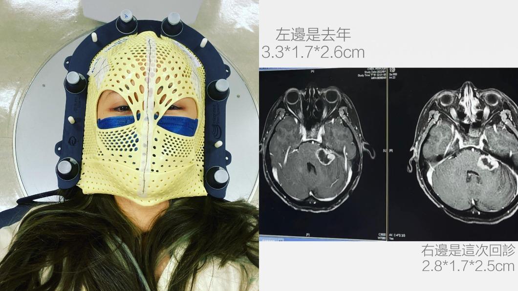 陳筱蕾罹患腦瘤，曬X光照透露近況。（圖／翻攝自陳筱蕾臉書）