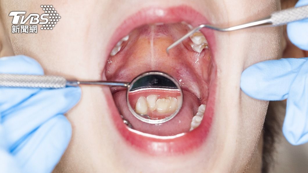 精神壓力巨大下，口腔內的牙齦經常首當其衝出問題。（示意圖／Shutterstock達志影像）