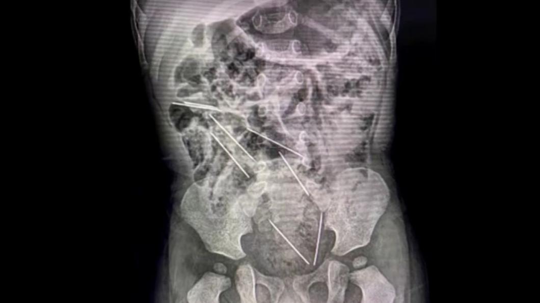 秘魯有位2歲男童誤將8根針頭吞進肚內。（圖／翻攝自 TV Azteca）