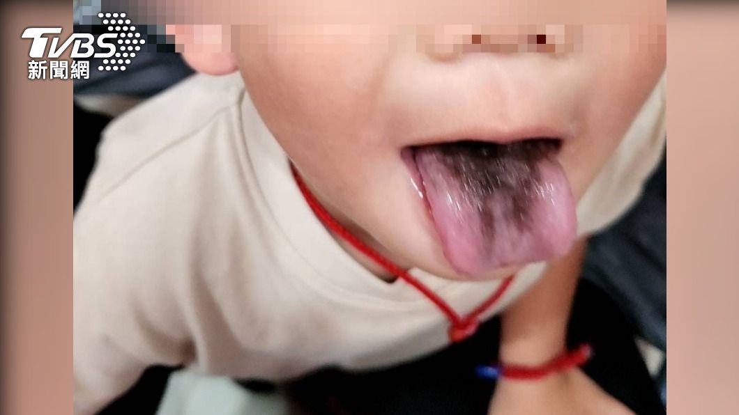 4歲童長出黑毛舌苔。（圖／TVBS）