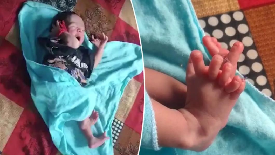 印度1名女嬰出生時就有26根手指和腳趾。（圖／翻攝自Twitter@DailyLoud）