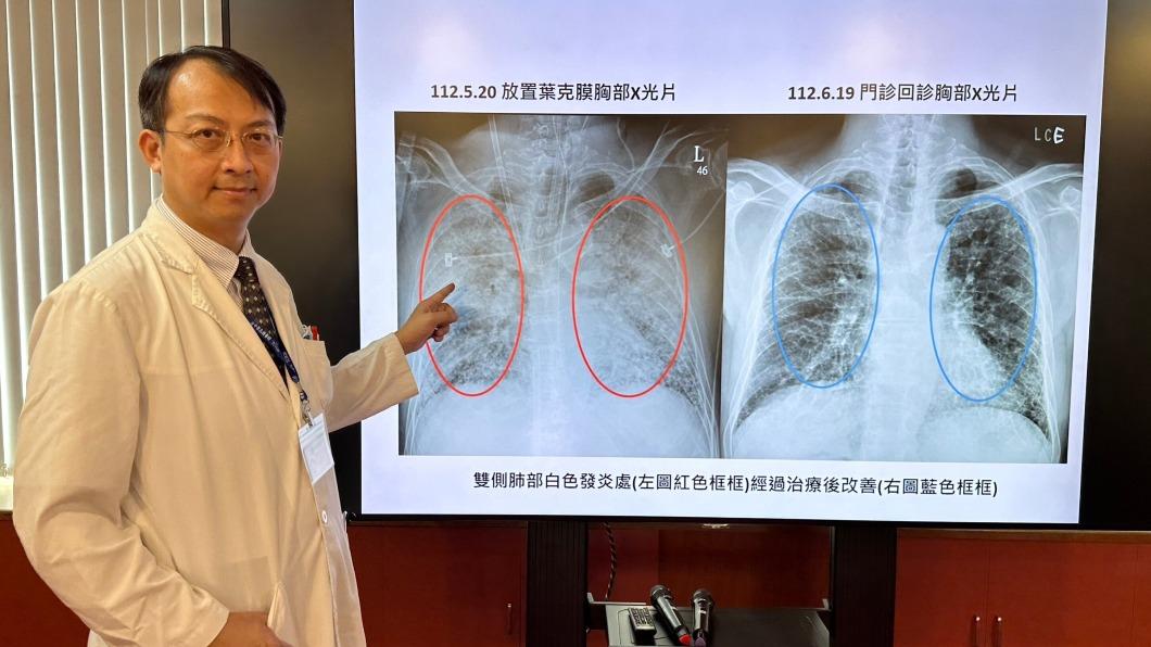 台中榮總呼吸治療科醫師王振宇說明患者的病況。（圖／台中榮總提供）